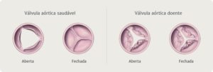 Healthy and diseased aortic valve comparison
