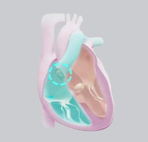 understanding aortic stenosis