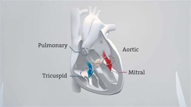 Transcatheter Aortic Valve (TAVI) Implantation