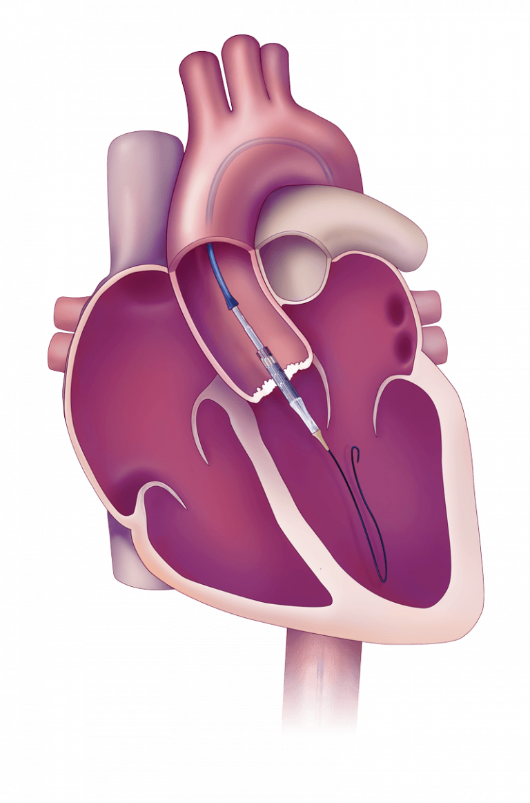 Was Ist Eine Transkatheter-Aortenklappenimplantation (TAVI)?