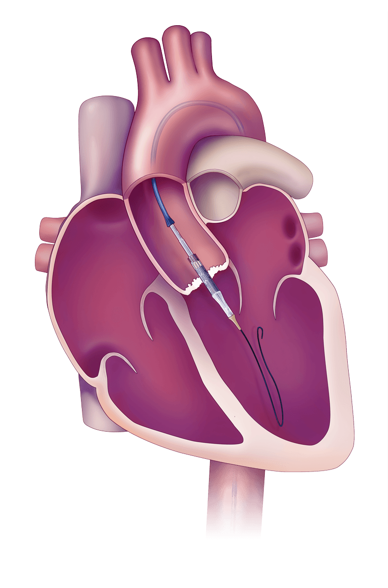 Was ist eine Transkatheter-Aortenklappenimplantation (TAVI)?