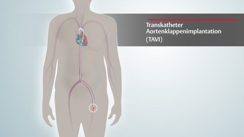 TAVI Procedure