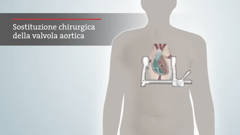 Cos’è la chirurgia a cuore aperto?
