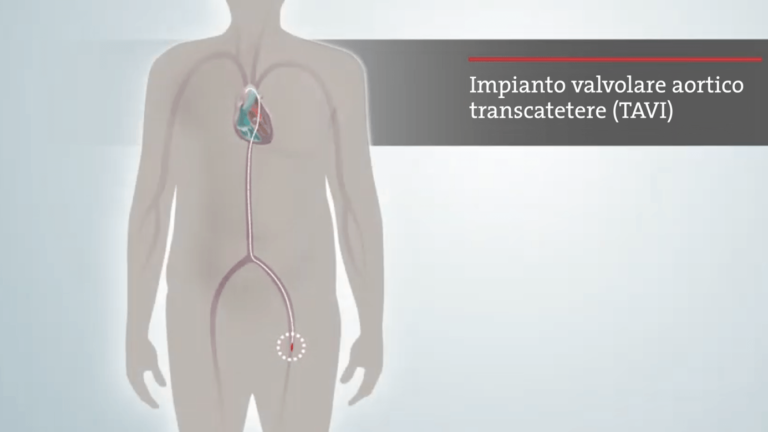 Cos’è la TAVI?