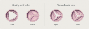 Healthy vs. Diseased Aortic Valve