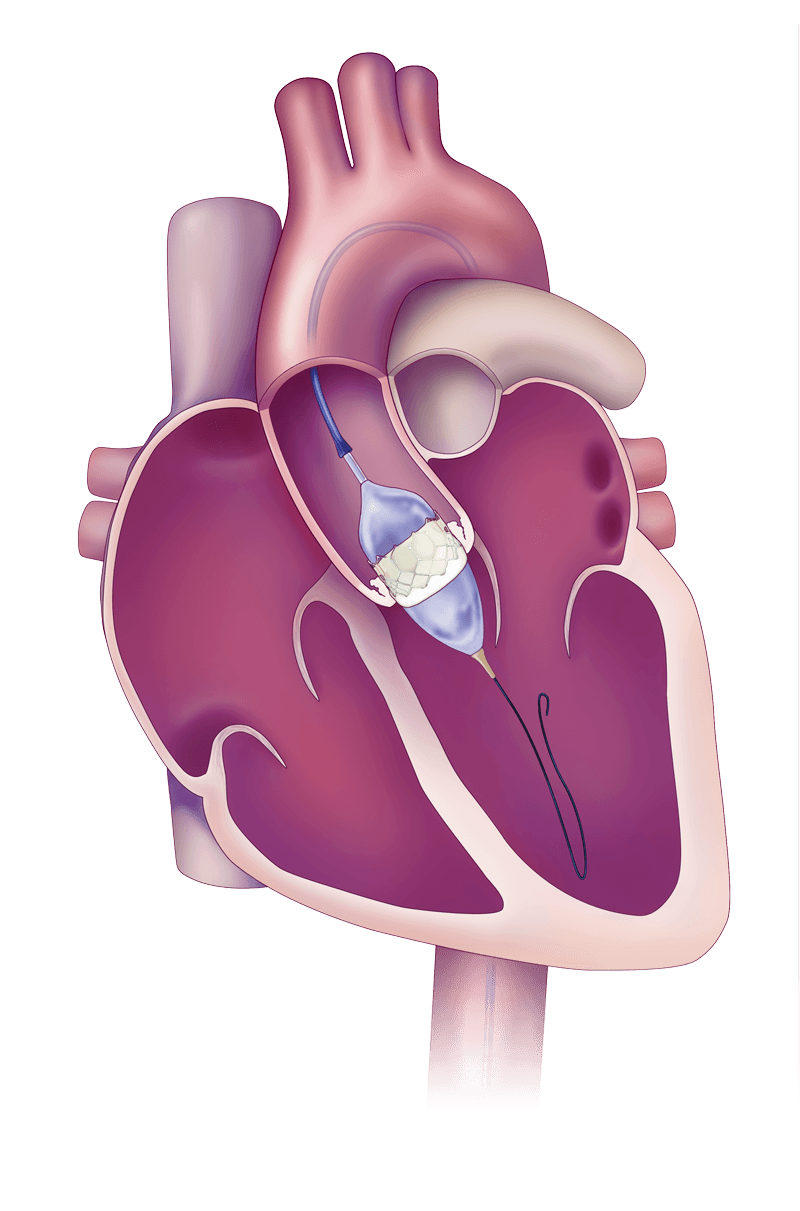 What Is A Transcatheter Aortic Valve Replacement (TAVI) Procedure?